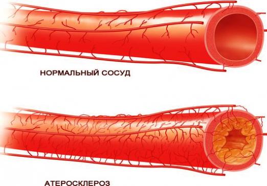Kas yra aterosklerozė?
